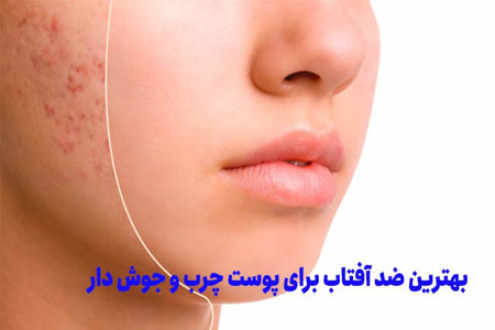 بهترین ضد افتاب برای پوست چرب و جوش دار
